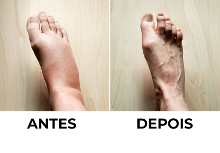 Imagem comparativa de antes e depois dos pés